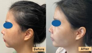 Chin Implant results