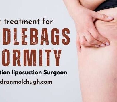 saddlebags deformity liposuction treatment
