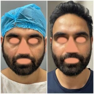 Facial Slimming Surgery