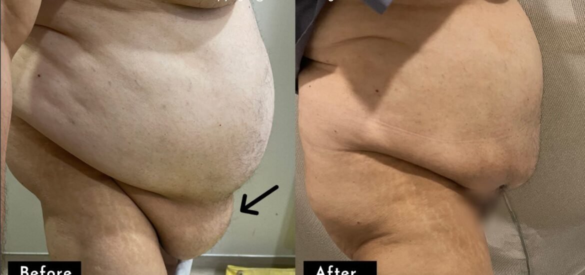 Panniculectomy Surgery Results