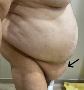 Panniculectomy before