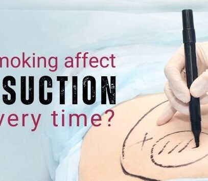 Can smoking affect liposuction recovery time