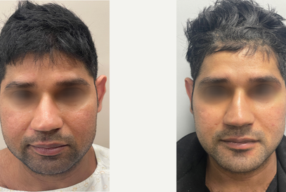 28 year old man treated with Ear Surgery (Left Otoplasty), Chin Implant