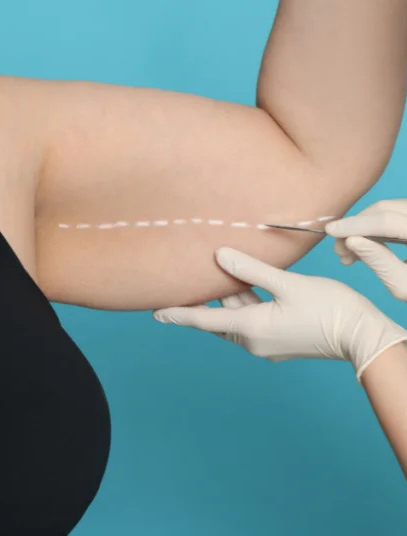 Tips for managing arm liposuction side effects for smooth recovery Tips for managing arm liposuction side effects for smooth recovery