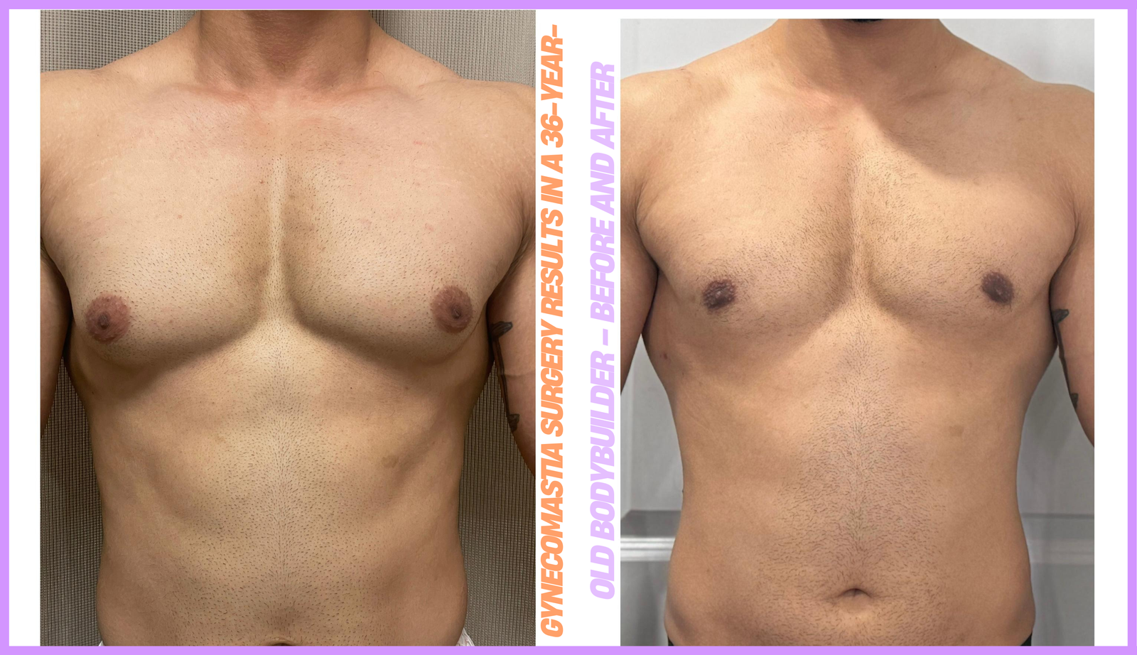 Gynecomastia surgery results in a 36-year-old bodybuilder – before and after