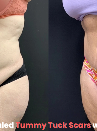 Close-up of well-healed tummy tuck scars with smooth skin