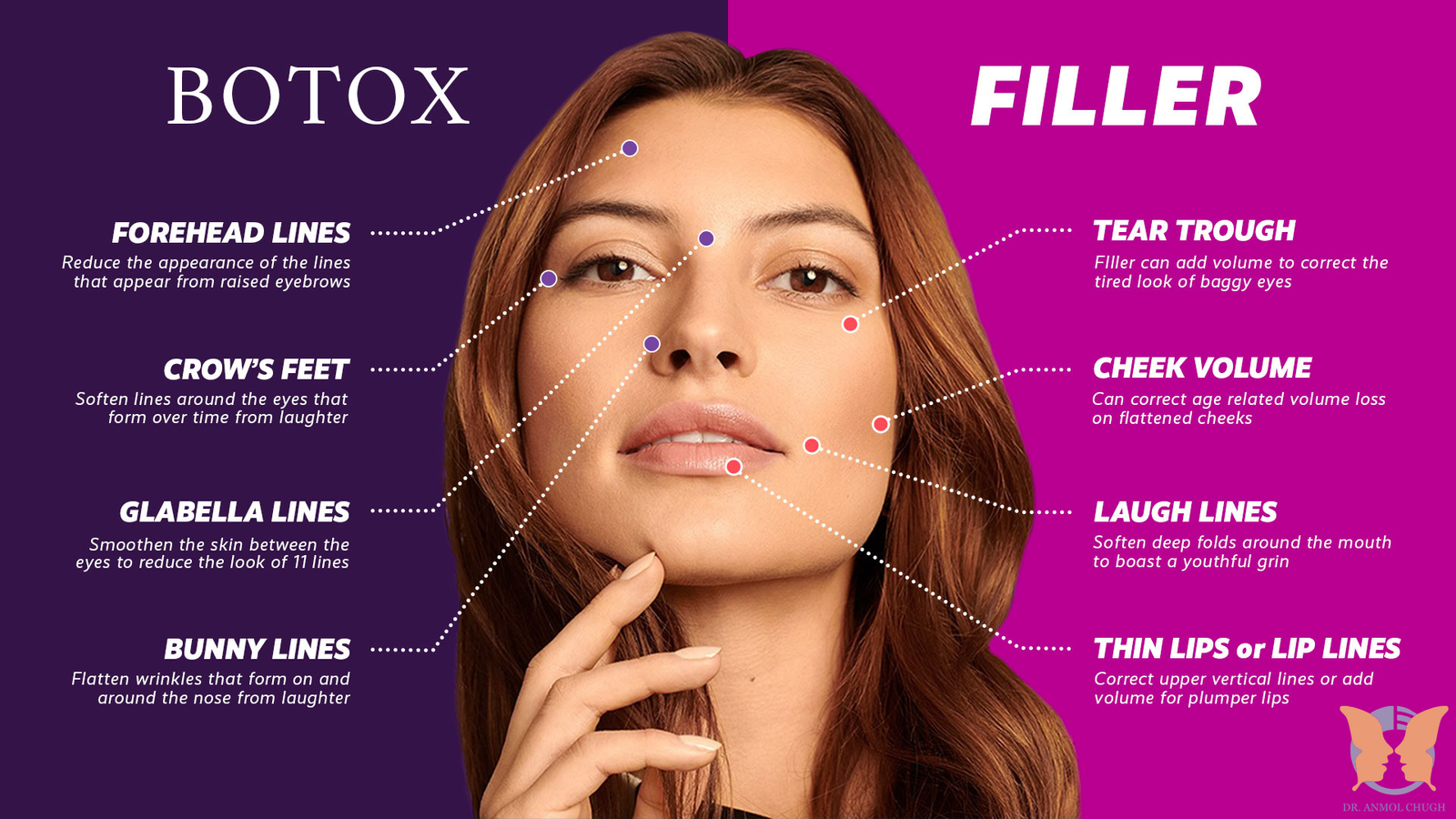 Comparison between fillers and Botox for facial rejuvenation and wrinkle reduction