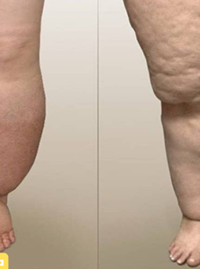 Comparison of lipedema and lymphedema – Key differences and treatment options Comparison of lipedema and lymphedema – Key differences and treatment options