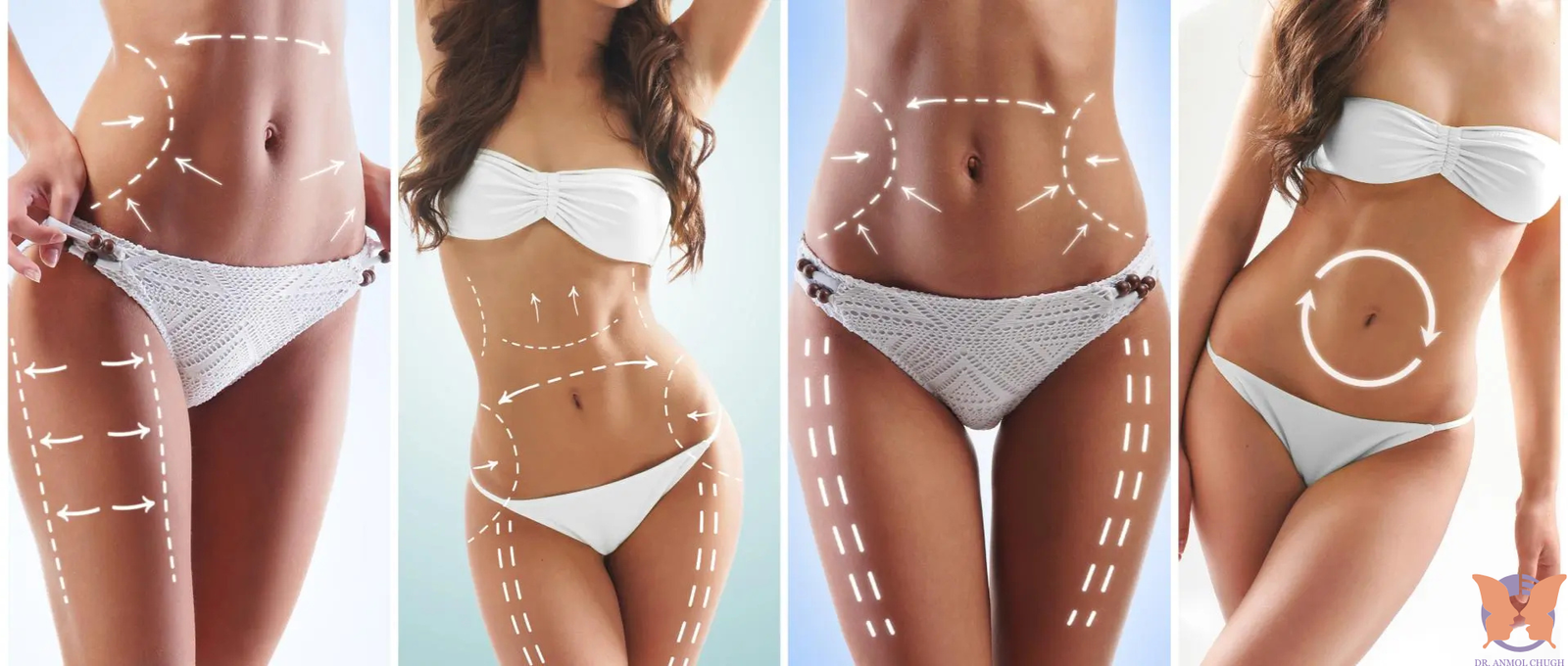 Illustration of how liposuction works to remove excess fat from the body