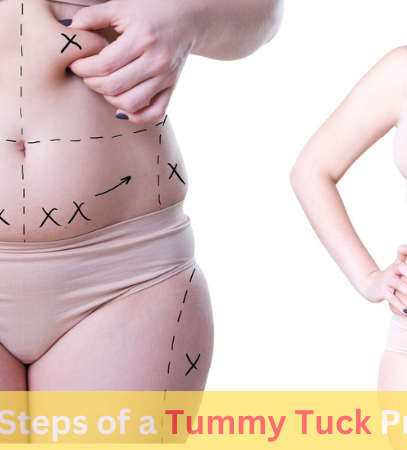 Steps of a tummy tuck procedure – From consultation to recovery